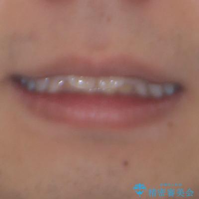 上顎前突とディープバイト ワイヤー矯正での確実に仕上げるの治療前(顔貌)