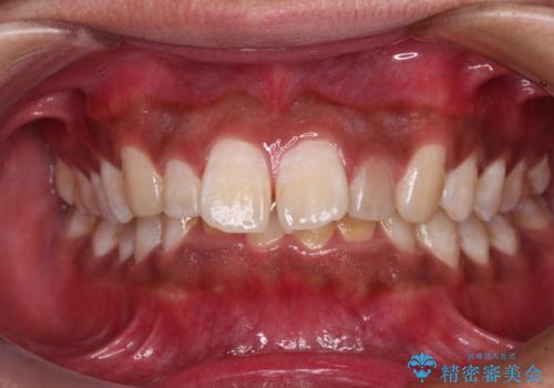 上顎前突とディープバイト ワイヤー矯正での確実に仕上げるの治療前