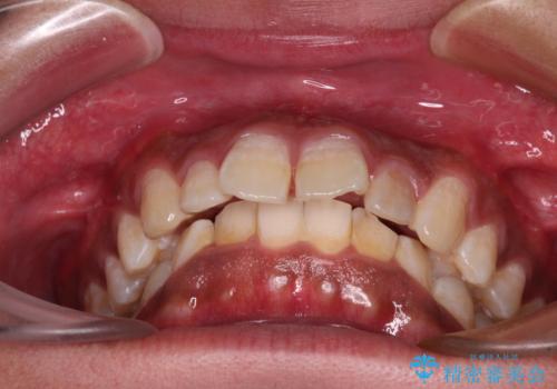 上顎前突とディープバイト ワイヤー矯正での確実に仕上げるの治療前