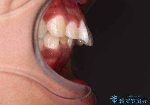 上顎前突とディープバイト ワイヤー矯正での確実に仕上げるの治療前