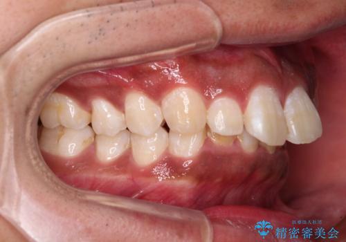 上顎前突とディープバイト ワイヤー矯正での確実に仕上げるの治療前