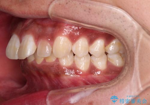 上顎前突とディープバイト ワイヤー矯正での確実に仕上げるの治療前