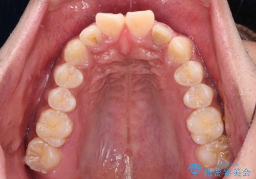 上顎前突とディープバイト ワイヤー矯正での確実に仕上げるの治療前