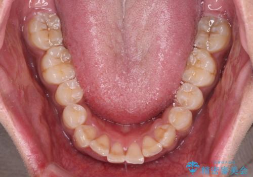 上顎前突とディープバイト ワイヤー矯正での確実に仕上げるの治療前