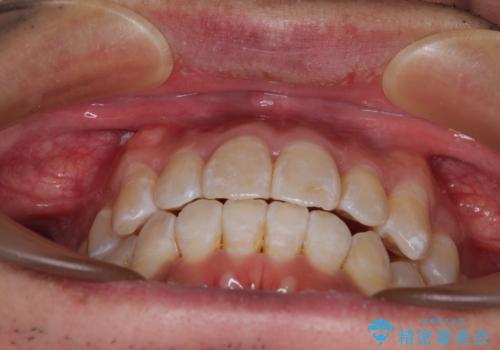 40代男性 今からでも遅くない インビザラインで綺麗な歯列を獲得の治療後