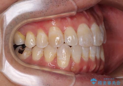 40代男性 今からでも遅くない インビザラインで綺麗な歯列を獲得の治療後