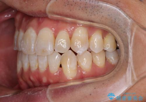 40代男性 今からでも遅くない インビザラインで綺麗な歯列を獲得の治療後