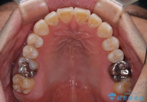 40代男性 今からでも遅くない インビザラインで綺麗な歯列を獲得の治療後