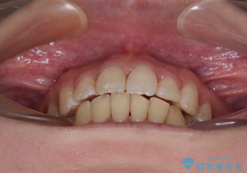 出っ歯を治したい ワイヤー装置での抜歯矯正で劇的変化!の治療後