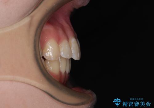 出っ歯を治したい ワイヤー装置での抜歯矯正で劇的変化!の症例 治療後