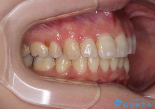 出っ歯を治したい ワイヤー装置での抜歯矯正で劇的変化!の治療後