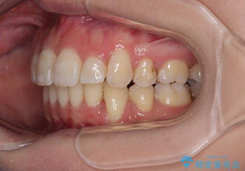 出っ歯を治したい ワイヤー装置での抜歯矯正で劇的変化!の治療後