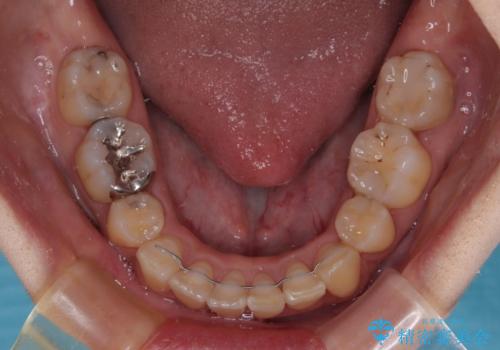 出っ歯を治したい　ワイヤー装置での抜歯矯正で劇的変化!の治療後