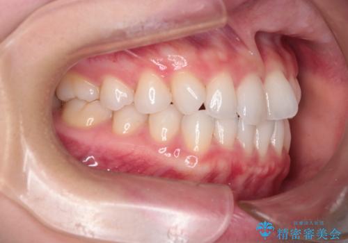 【インビザライン】前歯の凸凹をマウスピース矯正でなおしたいの治療前