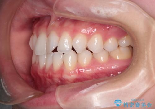 【インビザライン】前歯の凸凹をマウスピース矯正でなおしたいの治療前