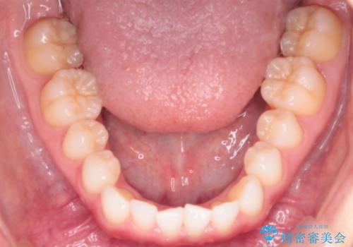 【インビザライン】前歯の凸凹をマウスピース矯正でなおしたいの治療前