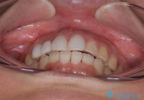 前歯のデコボコが気になる インビザラインによる矯正治療の治療後