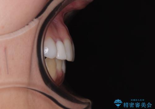 前歯のデコボコが気になる インビザラインによる矯正治療の治療後