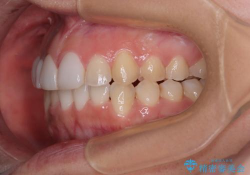 前歯のデコボコが気になる　インビザラインによる矯正治療の治療後