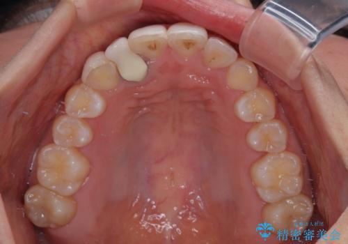 前歯のデコボコが気になる インビザラインによる矯正治療の治療後