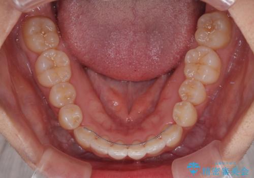 前歯のデコボコが気になる インビザラインによる矯正治療の治療後