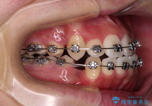 上下の八重歯とクロスバイト　ワイヤー装置での抜歯矯正の治療中