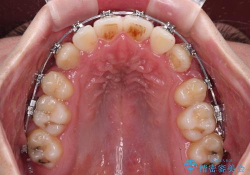 上下の八重歯とクロスバイト　ワイヤー装置での抜歯矯正の治療中