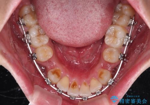 上下の八重歯とクロスバイト　ワイヤー装置での抜歯矯正の治療中