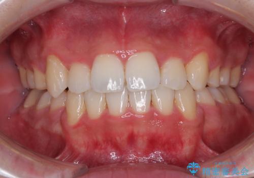 上下の八重歯とクロスバイト　ワイヤー装置での抜歯矯正の症例 治療後