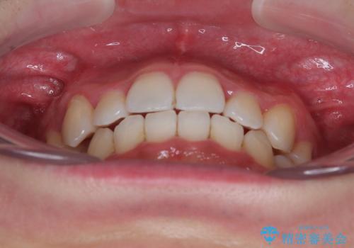 上下の八重歯とクロスバイト　ワイヤー装置での抜歯矯正の治療後