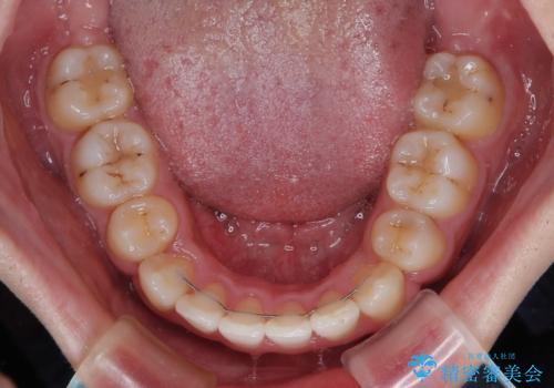 上下の八重歯とクロスバイト　ワイヤー装置での抜歯矯正の治療後