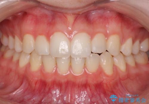 咬んでも前歯が閉じない　矯正治療で見た目を含めて改善の症例 治療後
