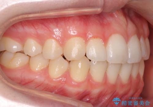 咬んでも前歯が閉じない　矯正治療で見た目を含めて改善の治療後