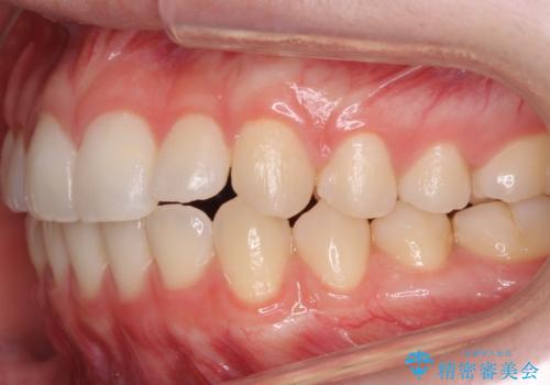 咬んでも前歯が閉じない 矯正治療で見た目を含めて改善の治療後