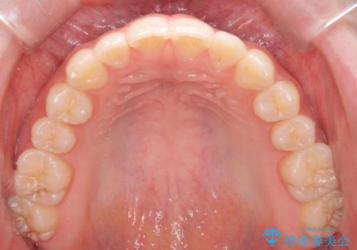 咬んでも前歯が閉じない　矯正治療で見た目を含めて改善の治療後