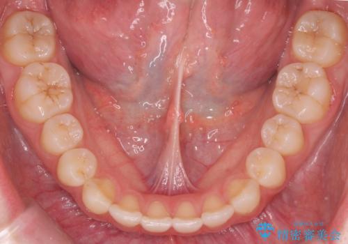 咬んでも前歯が閉じない 矯正治療で見た目を含めて改善の治療後