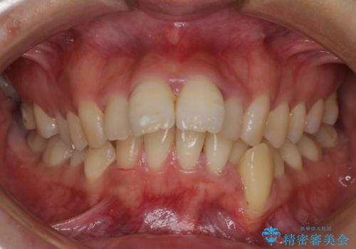 出っ歯を治したい ワイヤー装置での抜歯矯正で劇的変化!の治療前