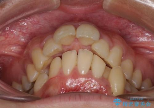 出っ歯を治したい ワイヤー装置での抜歯矯正で劇的変化!の治療前