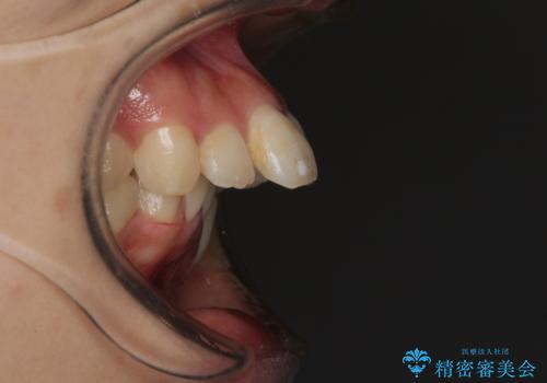 出っ歯を治したい　ワイヤー装置での抜歯矯正で劇的変化!の治療前