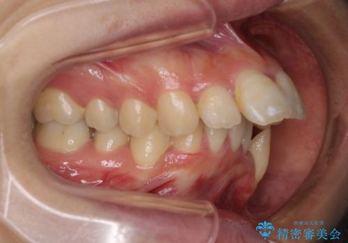 出っ歯を治したい　ワイヤー装置での抜歯矯正で劇的変化!の治療前