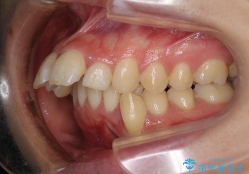 出っ歯を治したい ワイヤー装置での抜歯矯正で劇的変化!の治療前