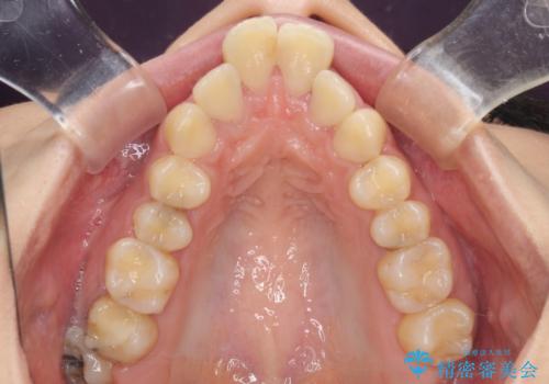 出っ歯を治したい ワイヤー装置での抜歯矯正で劇的変化!の治療前