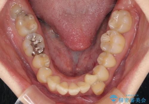 出っ歯を治したい ワイヤー装置での抜歯矯正で劇的変化!の治療前