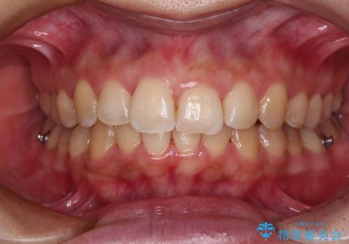 前歯のデコボコをインビザライン矯正で綺麗に改善の治療中