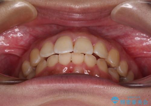 前歯のデコボコをインビザライン矯正で綺麗に改善の治療中