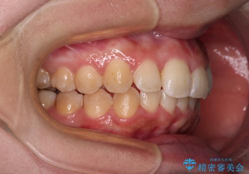 前歯のデコボコをインビザライン矯正で綺麗に改善の治療中