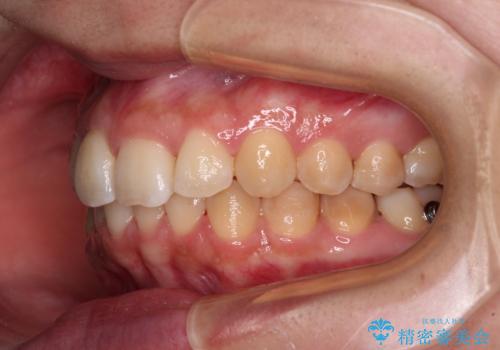 前歯のデコボコをインビザライン矯正で綺麗に改善の治療中