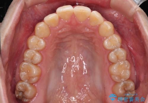 前歯のデコボコをインビザライン矯正で綺麗に改善の治療中