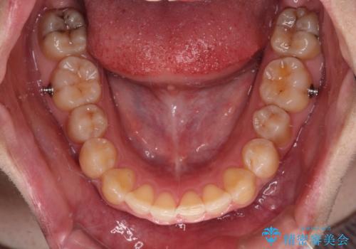 前歯のデコボコをインビザライン矯正で綺麗に改善の治療中