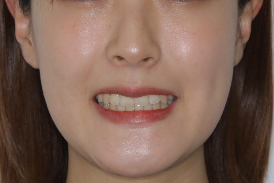 がたつきが強いガチャ歯。埋伏歯抜歯+矯正。すごいところに犬歯が埋まっていたのを抜いてワイヤー矯正治療の治療後(顔貌)